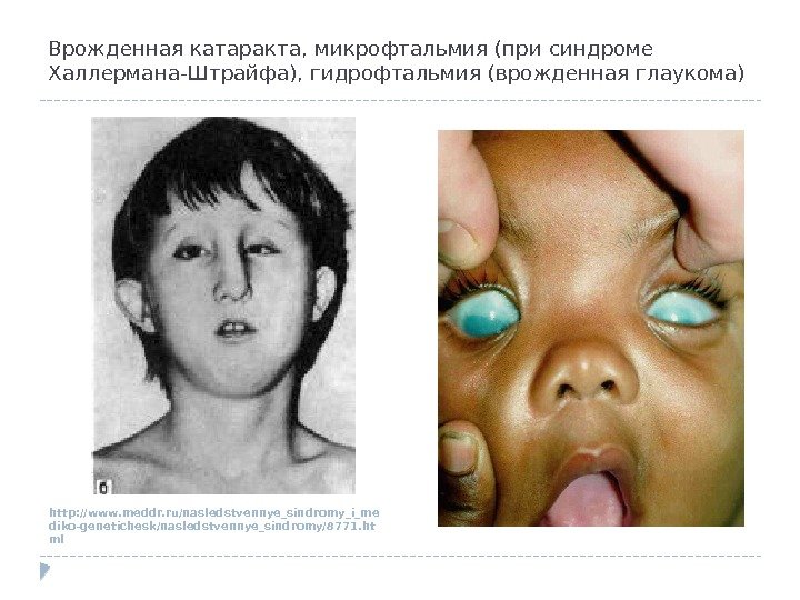Врожденная катаракта, микрофтальмия (при синдроме Халлермана-Штрайфа), гидрофтальмия (врожденная глаукома) http: //www. meddr. ru/nasledstvennye_sindromy_i_me diko-genetichesk/nasledstvennye_sindromy/8771.