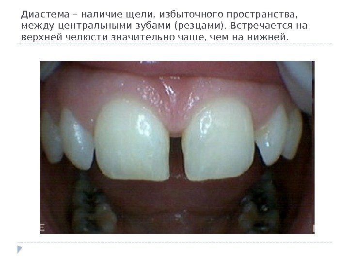Диастема – наличие щели, избыточного пространства,  между центральными зубами (резцами). Встречается на верхней