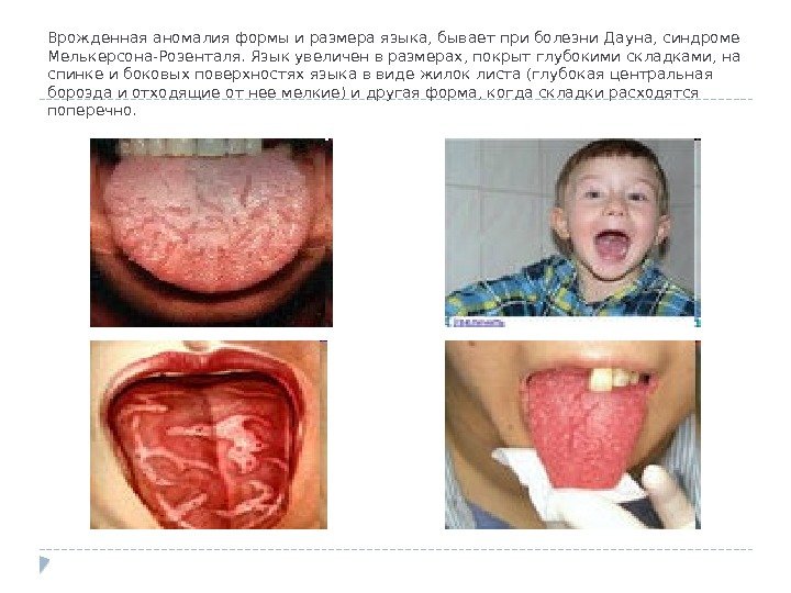 Врожденная аномалия формы и размера языка, бывает при болезни Дауна, синдроме Мелькерсона-Розенталя. Язык увеличен