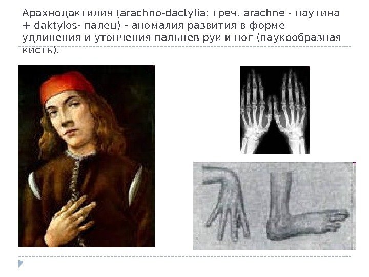 Арахнодактилия (arachno-dactylia; греч. arachne - паутина + daktylos- палец) - аномалия развития в форме