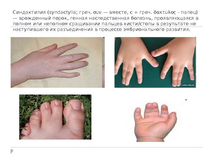 Синдактилия (syndactylia; греч. συν — вместе, с + греч. δακτυλος - палец) — врожденный