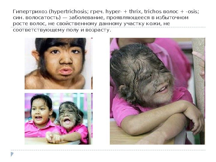 Гипертрихоз (hypertrichosis; греч. hyper- + thrix, trichos волос + -osis;  син. волосатость) —