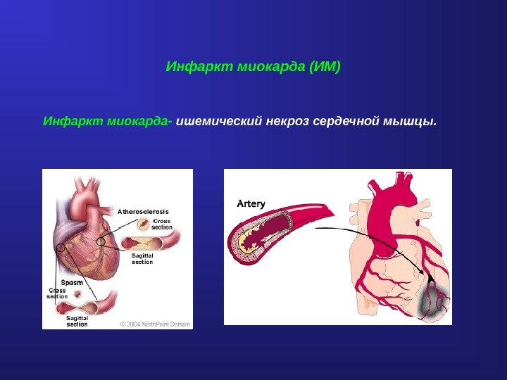 Инфаркт миокарда (ИМ) Инфаркт миокарда- ишемический некроз сердечной мышцы. 