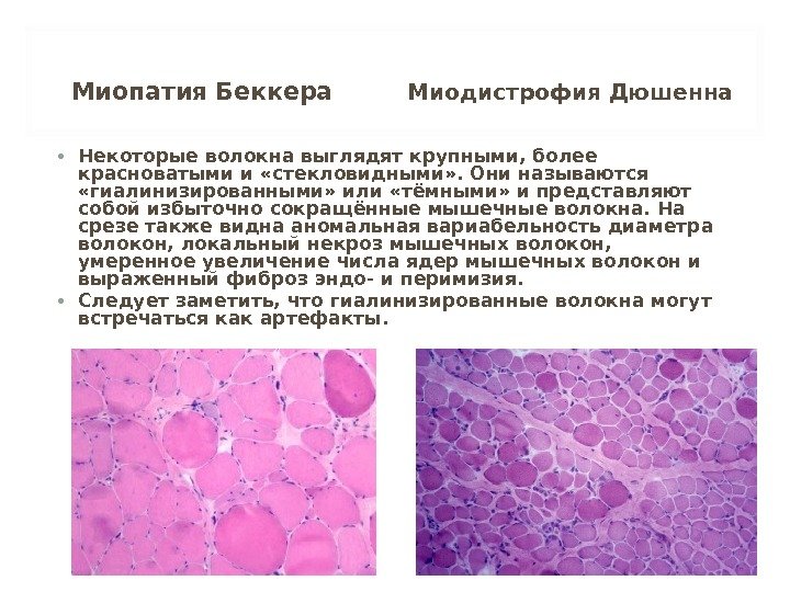 Мышечная дистрофия беккера