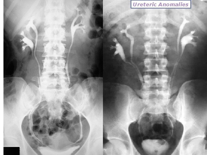 Ureteric Anomalies 