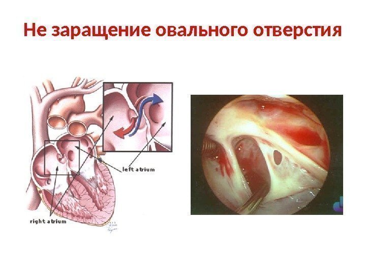 Не заращение овального отверстия 