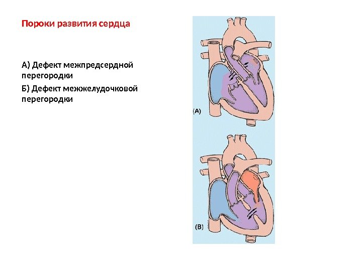Пороки развития сердца А) Дефект межпредсердной перегородки Б) Дефект межжелудочковой перегородки 