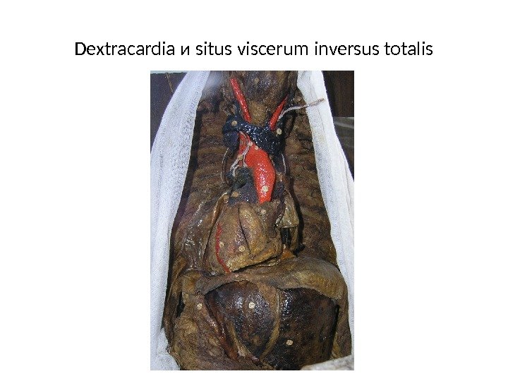 Dextracardia и situs viscerum inversus totalis 