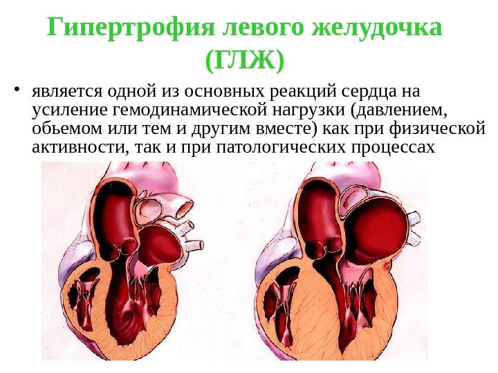 Гипертрофия левого желудочка (ГЛЖ) • является одной из основных реакций сердца на усиление гемодинамической