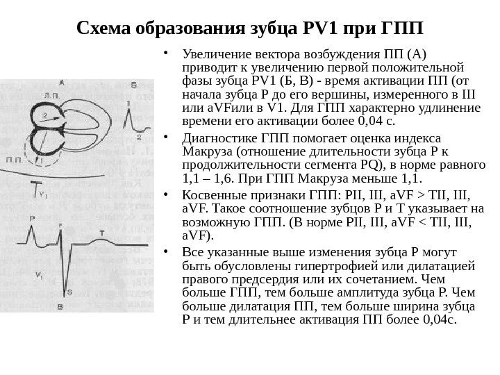 Схема образования зубца PV 1 при ГПП • Увеличение вектора возбуждения ПП (А) 