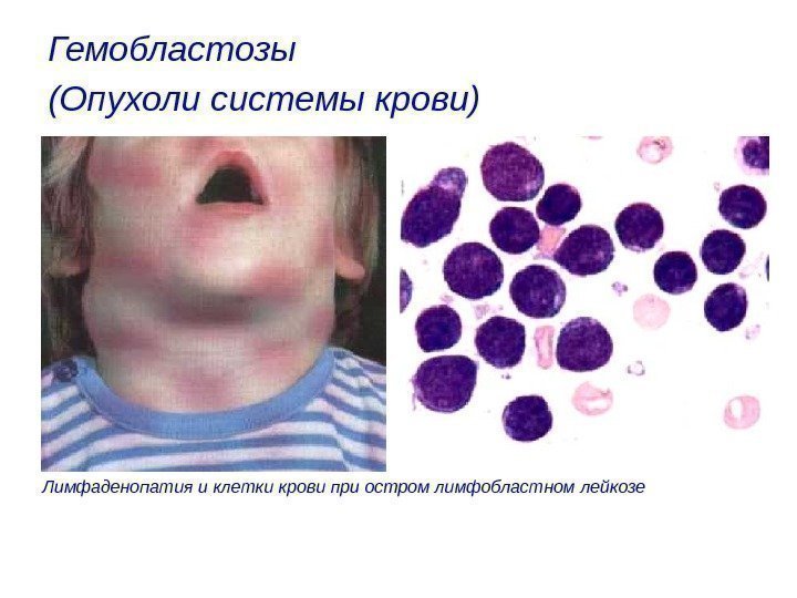 Гемобластозы (Опухоли системы крови)  Лимфаденопатия и клетки крови при остром лимфобластном лейкозе 