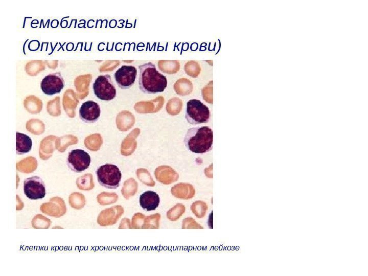 Гемобластозы (Опухоли системы крови)  Клетки крови при хроническом лимфоцитарном лейкозе 