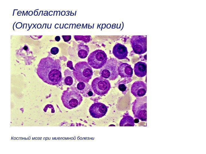 Гемобластозы (Опухоли системы крови)  Костный мозг при миеломной болезни 