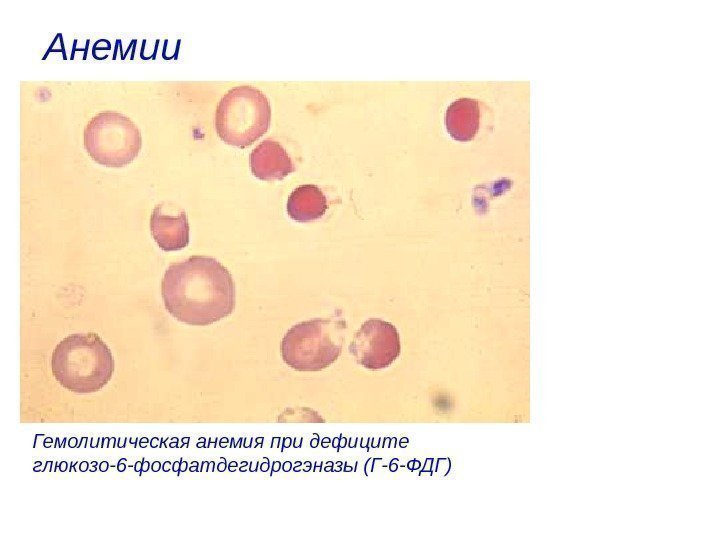 Анемии  Гемолитическая анемия при дефиците глюкозо-6 -фосфатдегидрогэназы (Г-6 -ФДГ) 