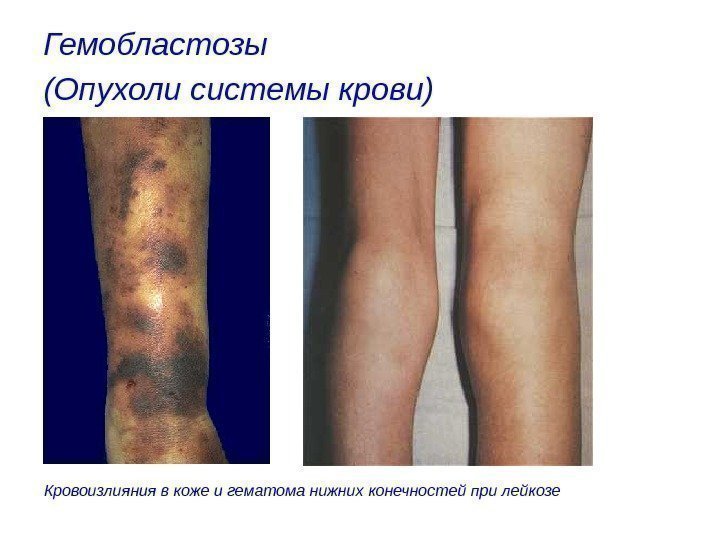 Гемобластозы (Опухоли системы крови)  Кровоизлияния в коже и гематома нижних конечностей при лейкозе