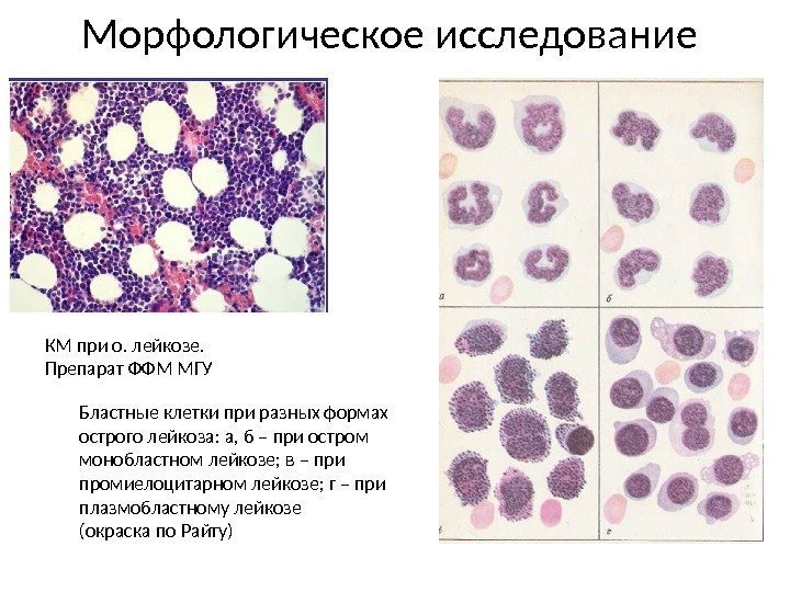 Морфологическое исследование. Морфологическая картина крови при лейкозах. Бластные клетки при остром лейкозе. Бластные клетки в крови лейкозах. Бластные клетки в крови при лейкозе.