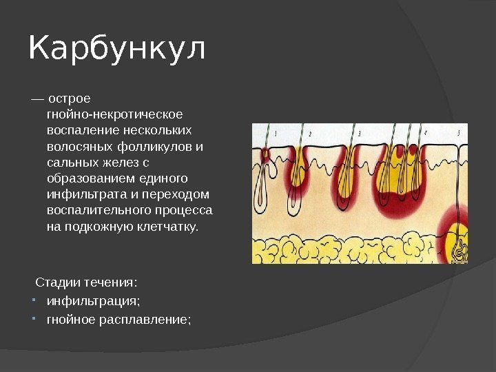 Карбункул — острое гнойно-некротическое воспаление нескольких волосяных фолликулов и сальных желез с образованием единого