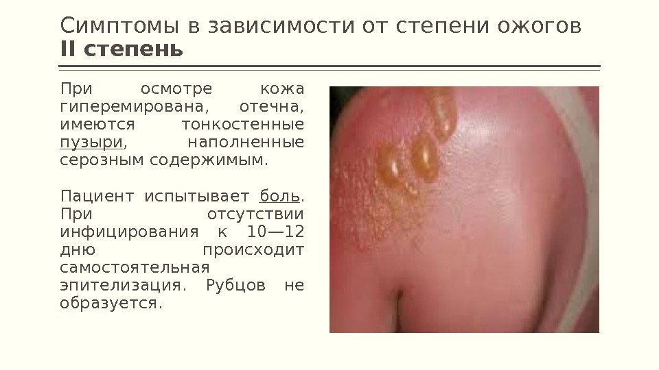 Симптомы в зависимости от степени ожогов II степень При осмотре кожа гиперемирована,  отечна,