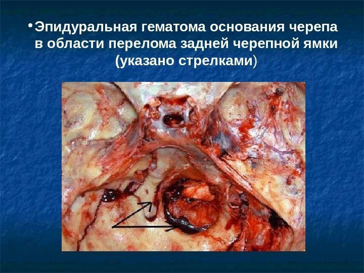  • Эпидуральная гематома основания черепа в области перелома задней черепной ямки (указано стрелками