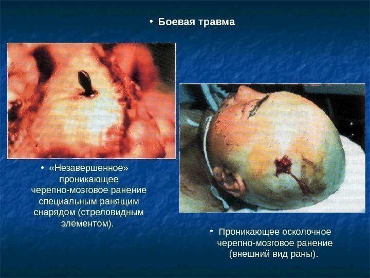  •  «Незавершенное»  проникающее черепно-мозговое ранение специальным  ранящим снарядом (стреловидным элементом).