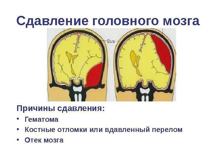   Сдавление головного мозга Причины сдавления:  • Гематома • Костные отломки или