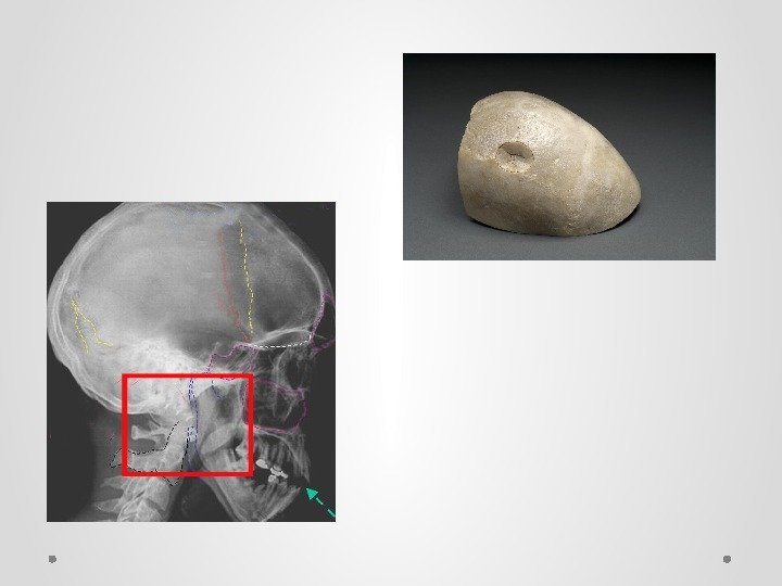 Презентация на тему перелом костей черепа