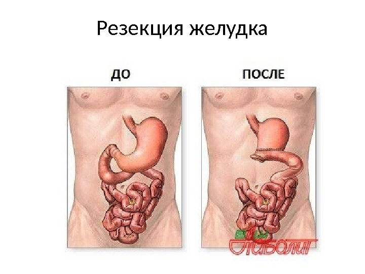 Резекция желудка 