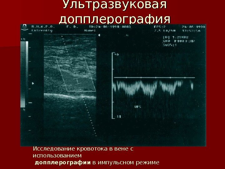 Ультразвуковая допплерография Исследование кровотока ввене с использованием допплерографии в импульсном режиме  