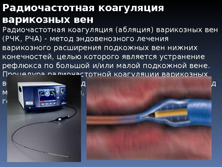 Операция рча отзывы пациентов. Аппарат для радиочастотной коагуляции вен. Эндовенозная лазерная облитерация вен. Эндоваскулярная лазерная абляция. Эндовазальная радиочастотная облитерация.
