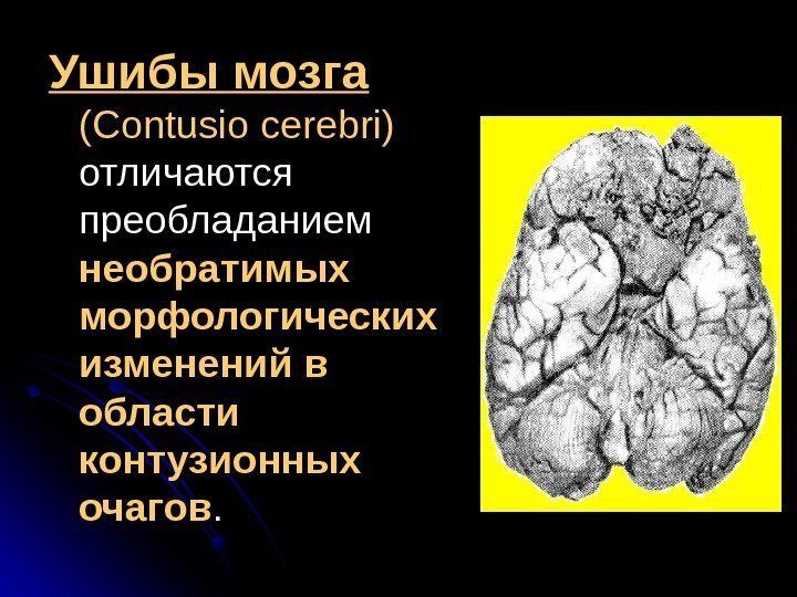   Ушибы мозга  (( Contusio cerebri)  отличаются преобладанием необратимых морфологических изменений
