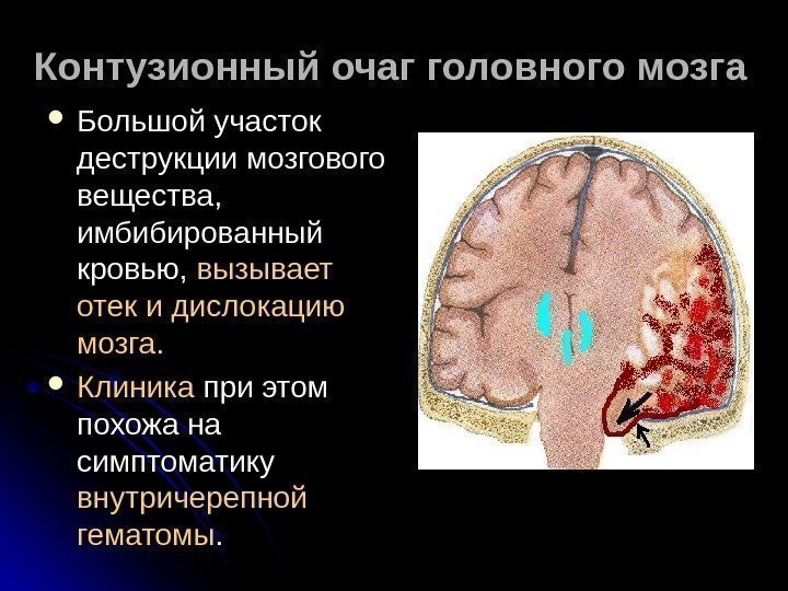   Контузионный очаг головного мозга Большой участок деструкции мозгового вещества,  имбибированный кровью,