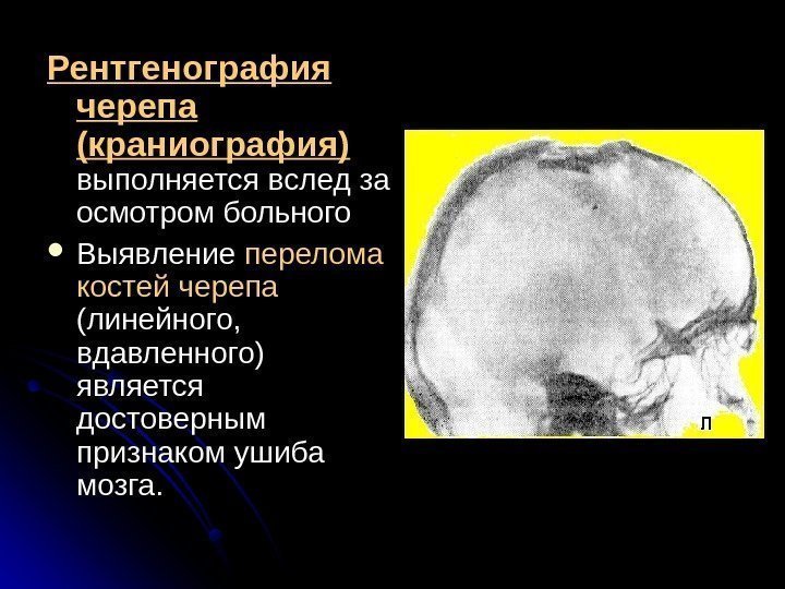   Рентгенография черепа (краниография)  выполняется вслед за осмотром больного Выявление перелома костей