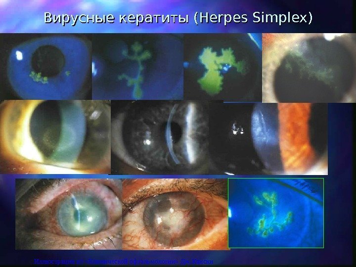 Вирусные кератиты ( Herpes Simplex )) Иллюстрации из «Клинической офтальмологии» Дж. Кански 