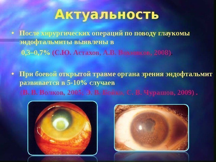  • После хирургических операций по поводу глаукомы  эндофтальмиты выявлены в  0,
