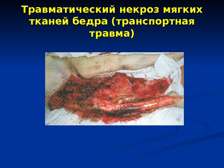 Травматический некроз мягких тканей бедра (транспортная травма) 