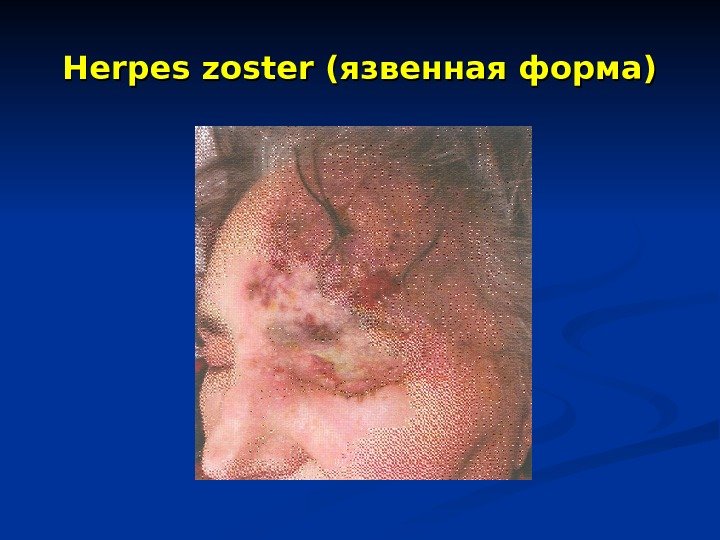 Herpes zoster (язвенная форма) 