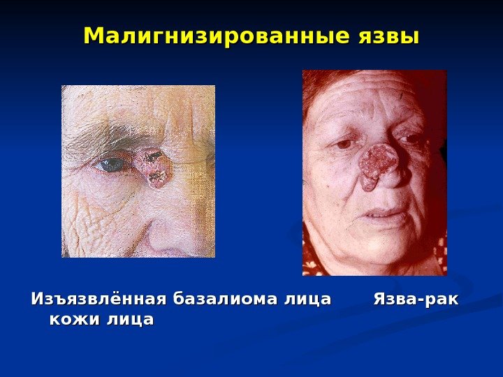 Малигнизированные язвы Изъязвлённая базалиома лица  Язва-рак кожи лица 