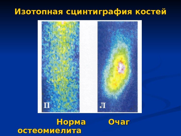   Изотопная сцинтиграфия костей       Норма  Очаг