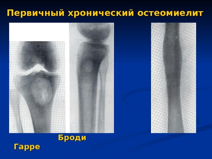   Первичный хронический остеомиелит        Броди 