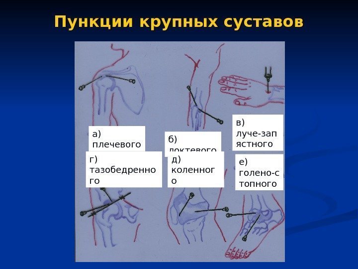   Пункции крупных суставов а) плечевого б) локтевого в) луче-зап ястного г) тазобедренно