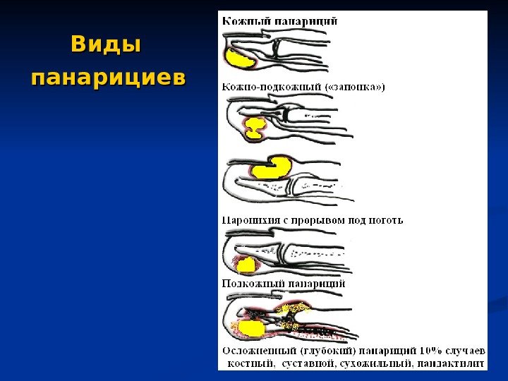 Панариций мкб 10 код