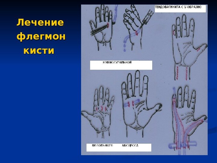  Лечение  флегмон  кисти 