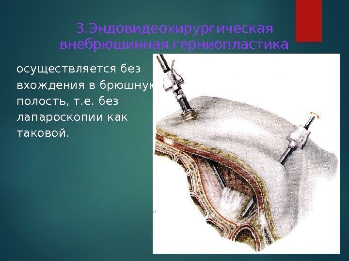 3. Эндовидеохирургическая внебрюшинная герниопластика осуществляется без вхождения в брюшную полость, т. е. без лапароскопии