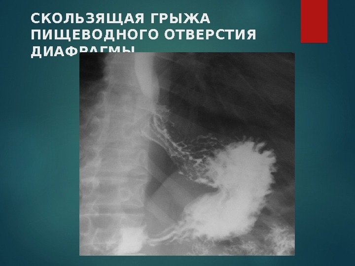 СКОЛЬЗЯЩАЯ ГРЫЖА ПИЩЕВОДНОГО ОТВЕРСТИЯ ДИАФРАГМЫ 