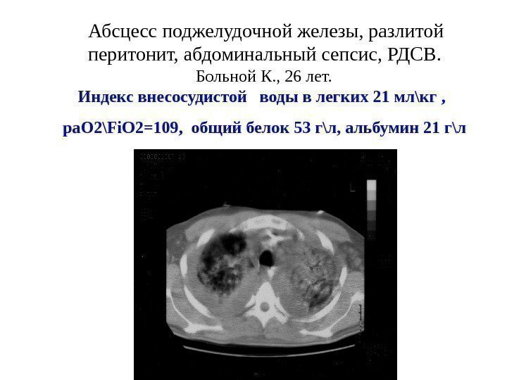 Абсцесс поджелудочной железы, разлитой перитонит, абдоминальный сепсис, РДСВ.  Больной К. , 26 лет.