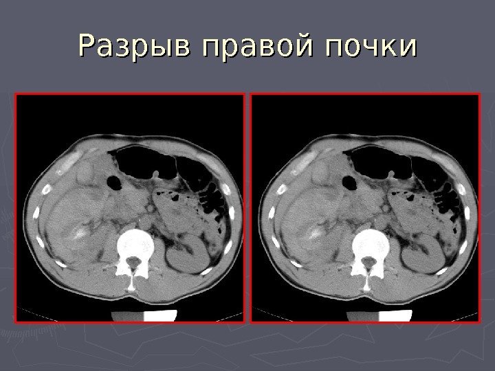   Разрыв правой почки 