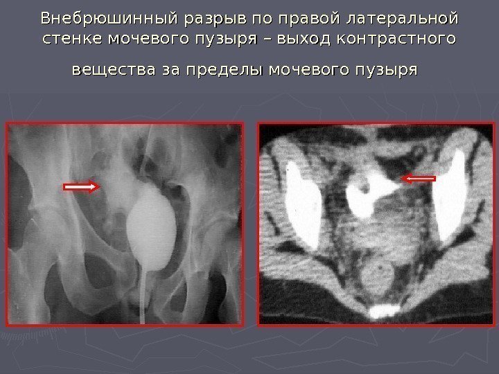   Внебрюшинный разрыв по правой латеральной стенке мочевого пузыря – выход контрастного вещества