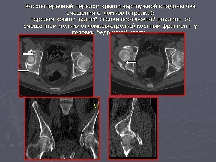   Косопоперечный перелом крыши вертлужной впадины без смещения отломков (стрелка); перелом крыши задней