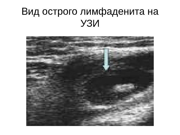 Вид острого лимфаденита на УЗИ 