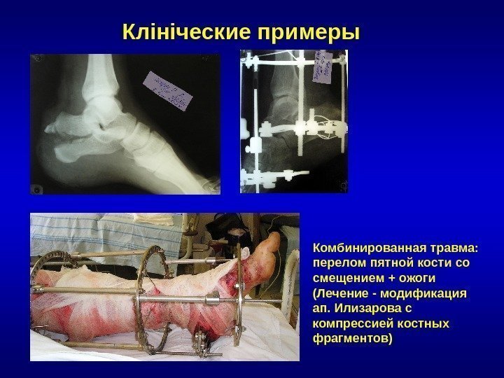 Клініческие примеры Комбинированная травма:  перелом пятной кости со смещением + ожоги (Лечение -